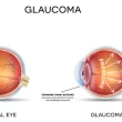 GLAUCOMA