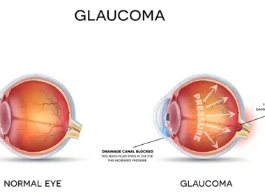 GLAUCOMA