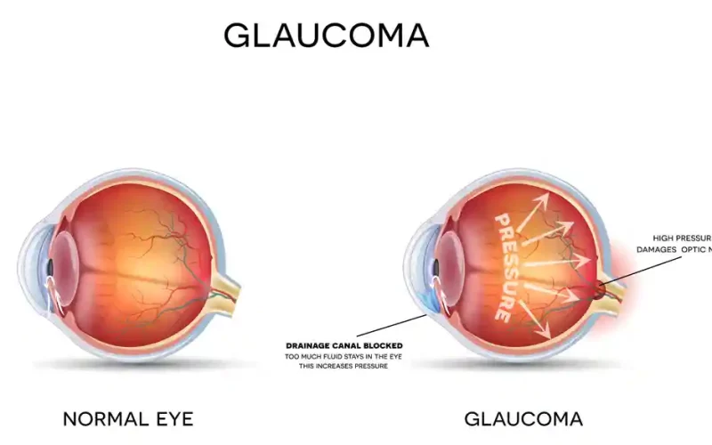 GLAUCOMA