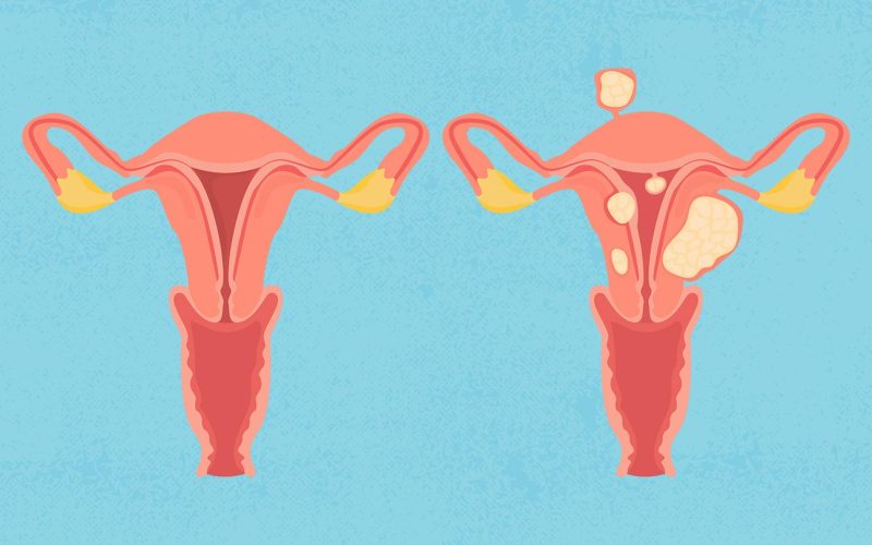 MENSTRUAL HEAVY BLEEDING