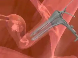 Embryo Transfer