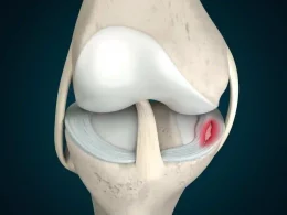 Meniscus Tear