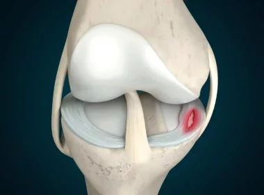 Meniscus Tear