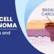 Basal Cell Carcinoma