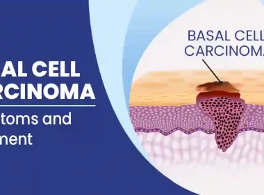 Basal Cell Carcinoma