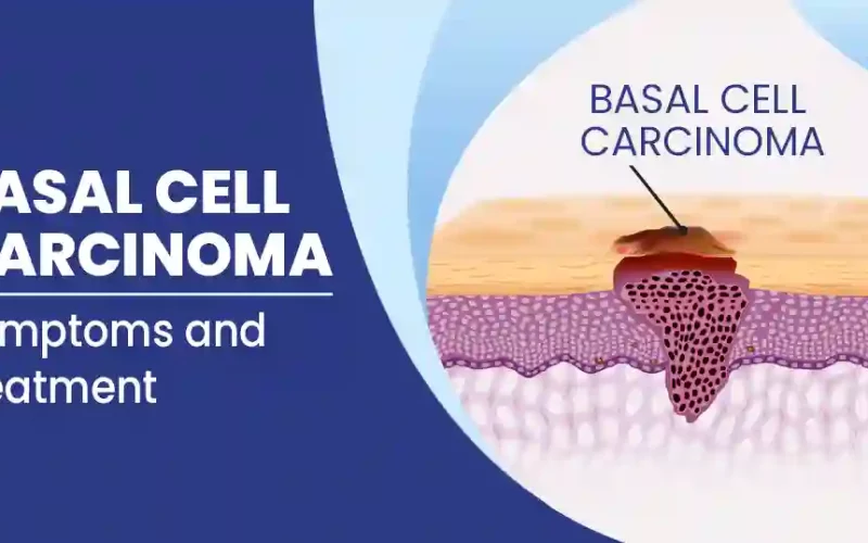 Basal Cell Carcinoma