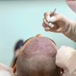 Hair Transplantation Procedure