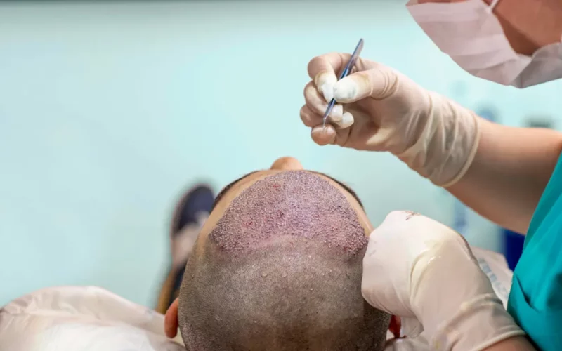 Hair Transplantation Procedure