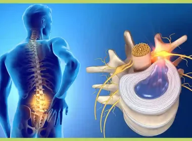 Herniated Disc