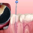 Root Canal