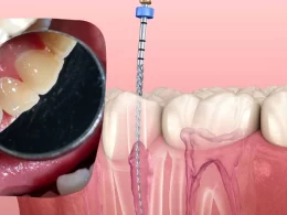 Root Canal