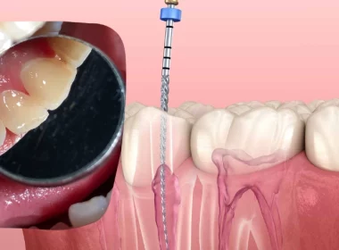 Root Canal