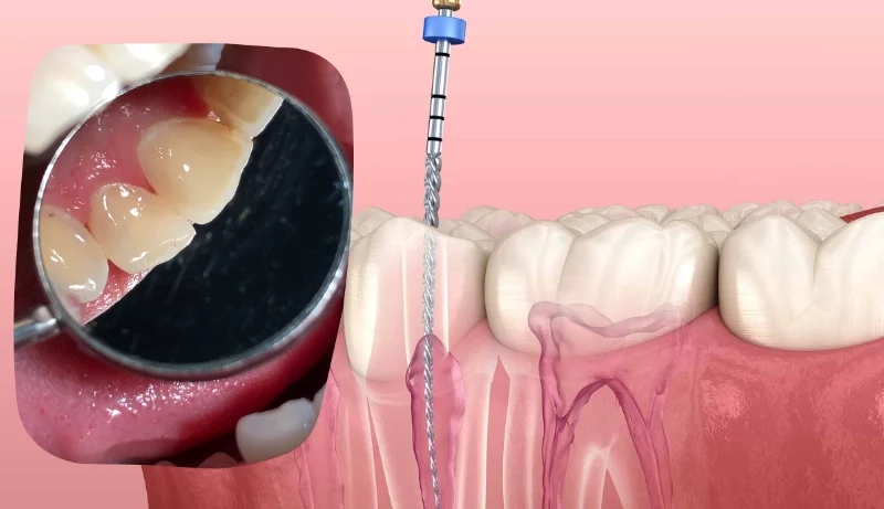 Root Canal