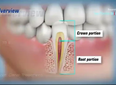 Root Canal Therapy