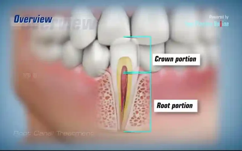 Root Canal Therapy