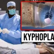 kyphoplasty chandler