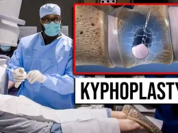 kyphoplasty chandler