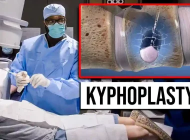 kyphoplasty chandler