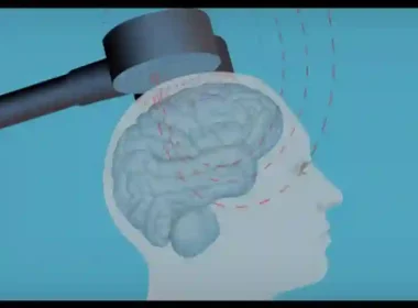 Transcranial Magnetic Stimulation