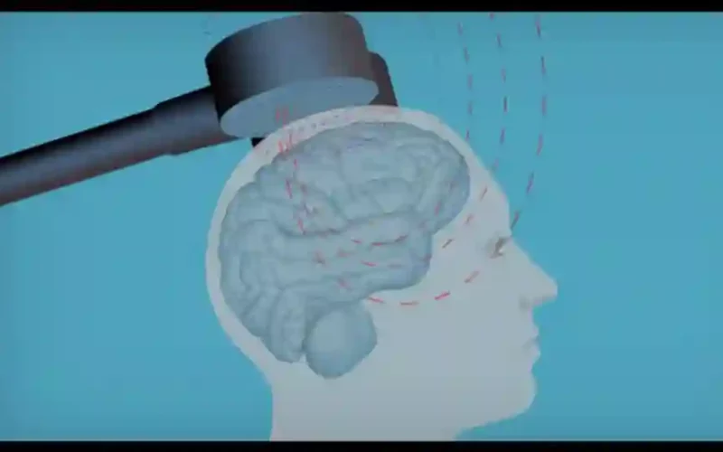 Transcranial Magnetic Stimulation