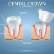 Dental Crown