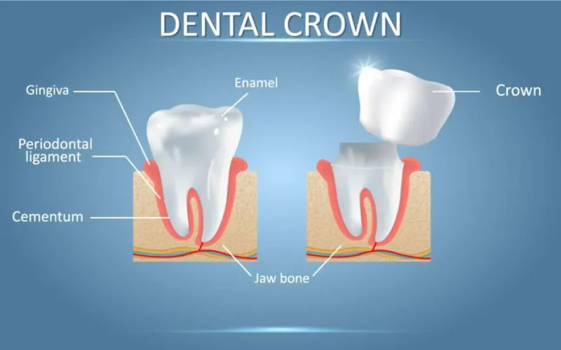 Dental Crown